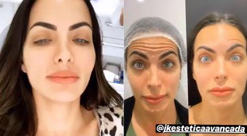 Carla Prata mostra antes e depois incrível de botox no rosto - Foto: Reprodução/ Instagram