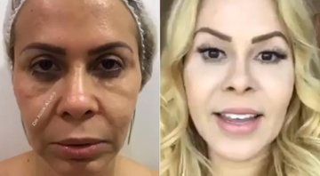 Joelma mostrou antes e depois de harmonização facial -Foto: Reprodução/ Instagram
