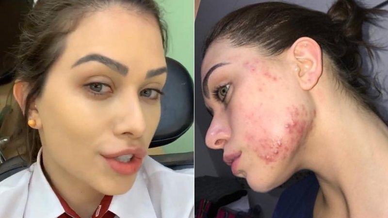 Flávia Pavanelli mostrou rosto tomado por espinhas e falou sobre o tratamento - Foto: Reprodução/ Instagram