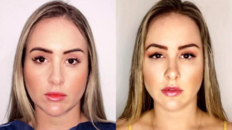 Ex-BBB Patrícia Leitte mostra harmonização facial e afirma já ter gasto R$ 65 mil em procedimentos - Foto: Reprodução/Instagram