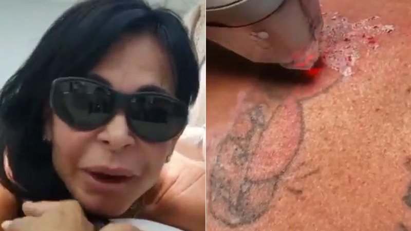 Gretchen mostrou processo de remoção de tatuagem na web - Foto: Reprodução/ Instagram