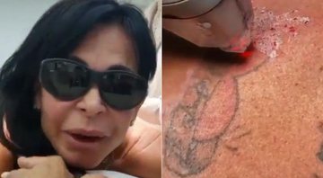 Gretchen mostrou processo de remoção de tatuagem na web - Foto: Reprodução/ Instagram