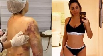 Ju Isen aparece com roxos no corpo todo após série de cirurgias plásticas - Foto: Reprodução/ Instagram