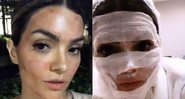 Kelly Key apareceu com o rosto cheio de ataduras e manhas de sangue após procedimento - Foto: Reprodução/ Instagram