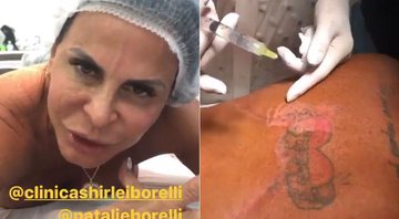 Gretchen mostrou remoção de tatuagem em vídeo - Foto: Reprodução/ Instagram