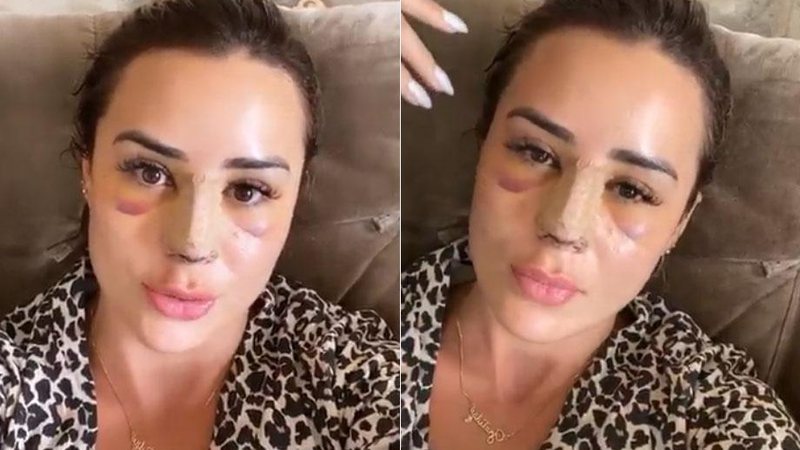 Letícia Santiago exibiu rosto inchado e roxo na web - Foto: Reprodução/ Instagram