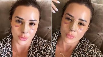 Letícia Santiago exibiu rosto inchado e roxo na web - Foto: Reprodução/ Instagram
