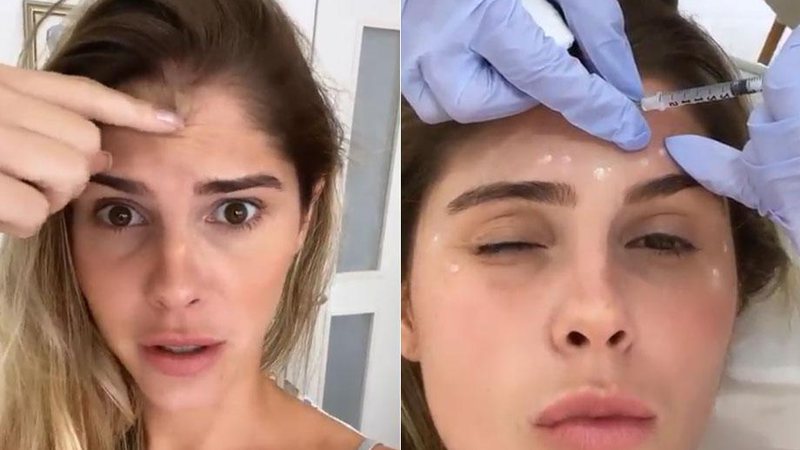 Bárbara Evans renovou o botox, fez preenchimento labial e peeling - Foto: Reprodução/ Instagram