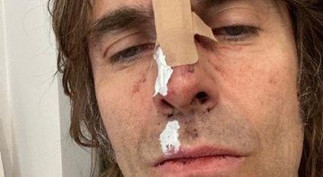 Liam Gallagher sofreu acidente após cair de helicóptero - Foto: Reprodução / Instagram