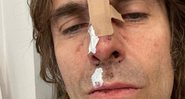 Liam Gallagher sofreu acidente após cair de helicóptero - Foto: Reprodução / Instagram