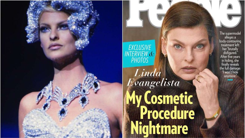 Linda Evangelista antes e depois: desfigurada por um procedimento estético - Foto: Reprodução / People