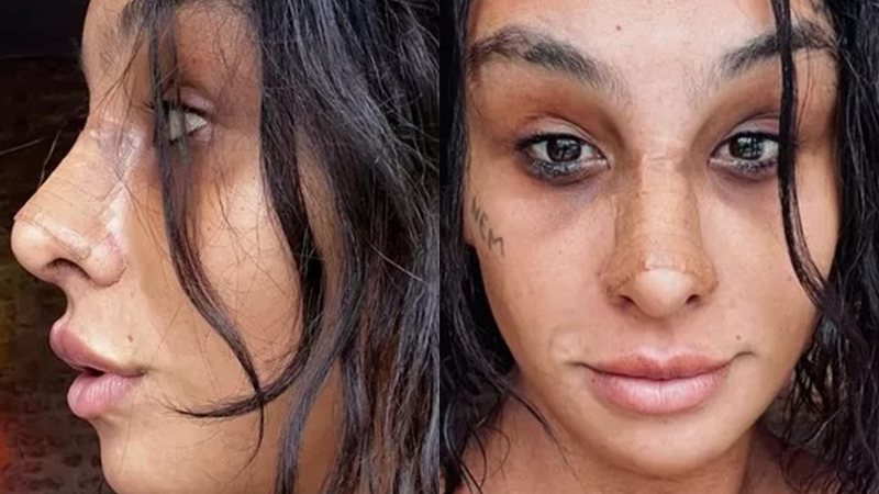 Linn da Quebrada compratilha novos cliques em seu Instagram para mostrar resultado da cirurgia - Foto: Reprodução / Instagram