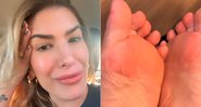 Lorena Improta mostrou pés cheios de bolhas após ensaios - Foto: Reprodução/ Instagram@loreimprota