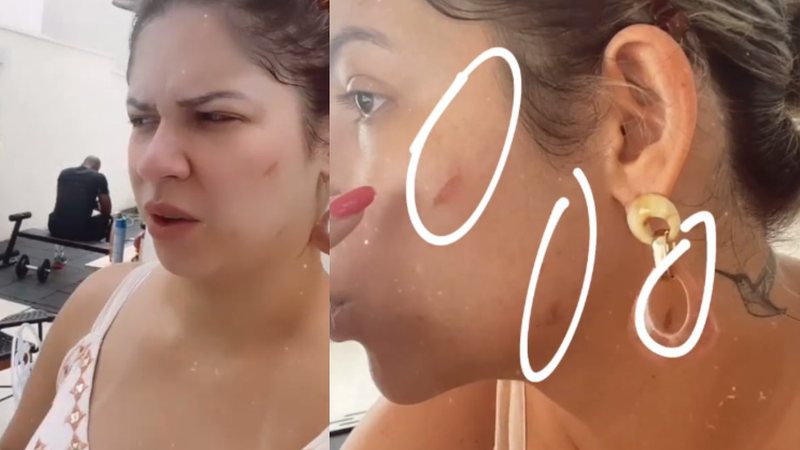 Marília machucou o pescoço, a mandíbula e o queixo com a chapinha - Reprodução/Instagram