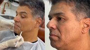 Maurício Mattar antes de realizar a harmonização facial