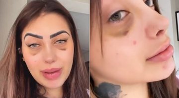 MC Mirella exibiu o novo nariz na web após rinoplastia - Foto: Reprodução/ Instagram
