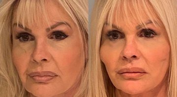 Monique Evans mostrou antes e depois de procedimento no rosto - Foto: Reprodução/ Instagram@moniquevansreal