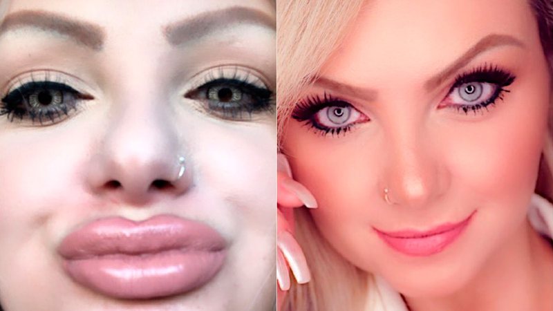 Suélem Cury, a Mulher Pêra, mostrou antes e depois de preenchimento labial - Foto: Reprodução/ Instagram@mulherperaoficial