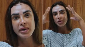 Nicole Bahls recorreu ao transplante capilar após quadro de alopecia - Foto: Reprodução/ Instagram@drrenanbrigante