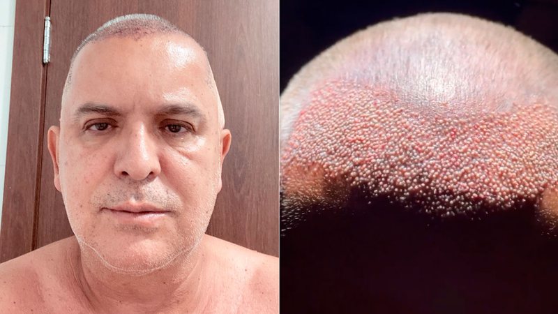 Orlando Morais apareceu careca antes de transplante capilar - Foto: Reprodução/ Instagram@orlandomorais e @drandersonlima