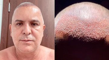 Orlando Morais apareceu careca antes de transplante capilar - Foto: Reprodução/ Instagram@orlandomorais e @drandersonlima