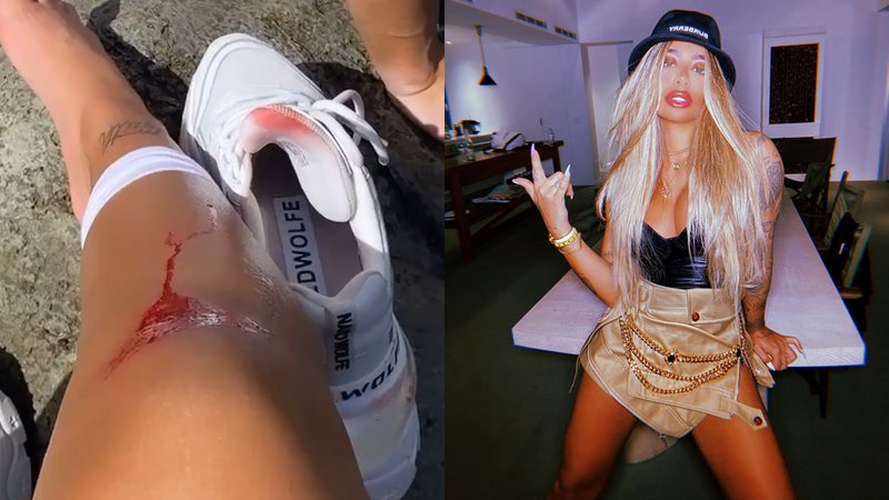Rafaella Santos e sua perna machucada - Reprodução/Instagram@rafaella