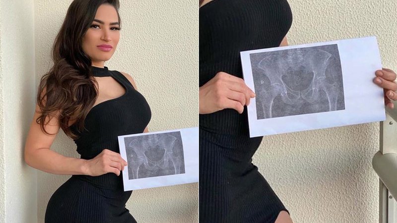 Raissa Barbosa mostrou raio-x que fez para provar que seu bumbum e natural - Foto: Reprodução/ Instagram