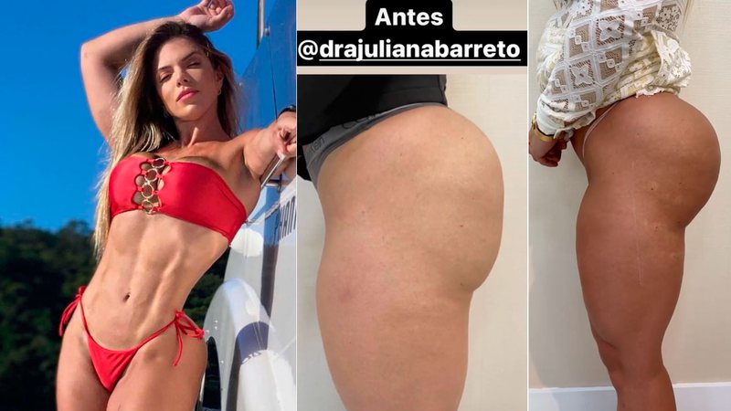 Roberta Zuniga mostrou antes e depois de procedimento no bumbum - Foto: Reprodução/ Instagram@robertazuniga