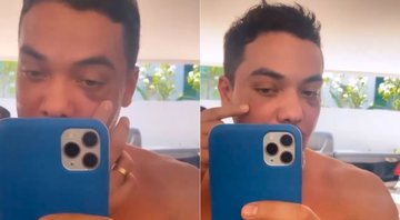 Wesley Safadão apareceu com olhos roxos após procedimento para eliminar olheiras - Foto: Reprodução/ Instagram