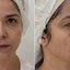 Samara Felippo mostrou antes e depois de procedimento para rejuvenescer