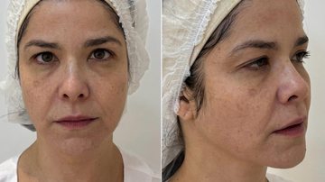 Samara Felippo mostrou antes e depois de procedimento para rejuvenescer