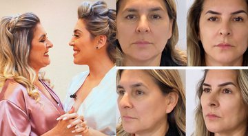 Naiara Azevedo usou seu Instagram para mostrar comparação do rosto da mãe após procedimento - Reprodução/Instagram
