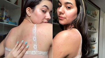 Alérgica a água, Thaleesa Silva fico com o corpo todo marcado após o banho - Foto: Reprodução/ Instagram