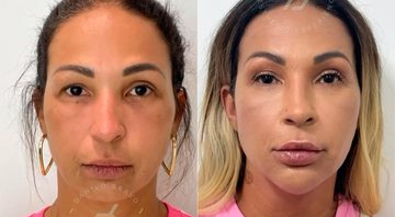 Valesca Popozuda mostrou mudança no rosto nos últimos três anos - Foto: Reprodução/ Instagram@valescapopozuda