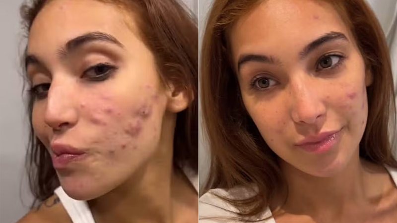 Vanessa Lopes mostrou a evolução do tratamento contra a acne severa - Foto: Reprodução/ Instagram@vanessalopesr_