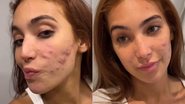 Vanessa Lopes mostrou a evolução do tratamento contra a acne severa - Foto: Reprodução/ Instagram@vanessalopesr_