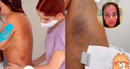 Victoria Villarim mostrou hematomas e falou sobre recuperação de lipo lad - Foto: Reprodução/ Instagram@victoriavillarim