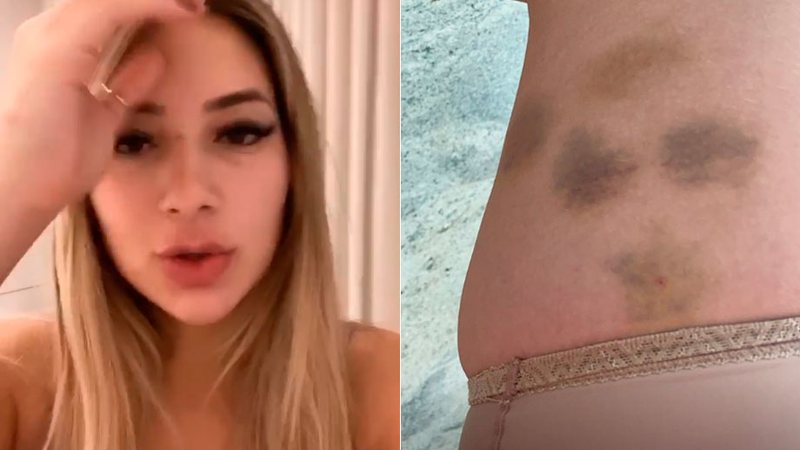 Imagem Virginia Fonseca mostra roxos após lipo LAD: “Ferrou minha perna”