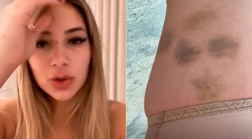 Imagem Virginia Fonseca mostra roxos após lipo LAD: “Ferrou minha perna”