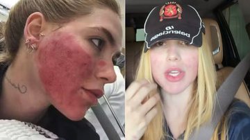 Virginia diz que se arrepende de procedimento que deixou rosto em “carne viva”