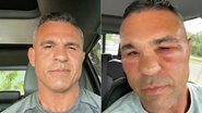 Vitor Belfort mostrou rosto inchado após implante capilar