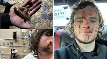 O youtuber WhistlinDiesel mostra bala que o atingiu na cabeça depois de ricochetear - Foto: Reprodução / Instagram@WhistlinDiesel
