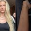 Yasmin Brunet mostrou roxos na perna e falou sobre lipedema