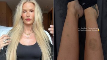 Yasmin Brunet mostrou roxos na perna e falou sobre lipedema