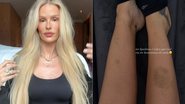 Yasmin Brunet mostrou roxos na perna e falou sobre lipedema
