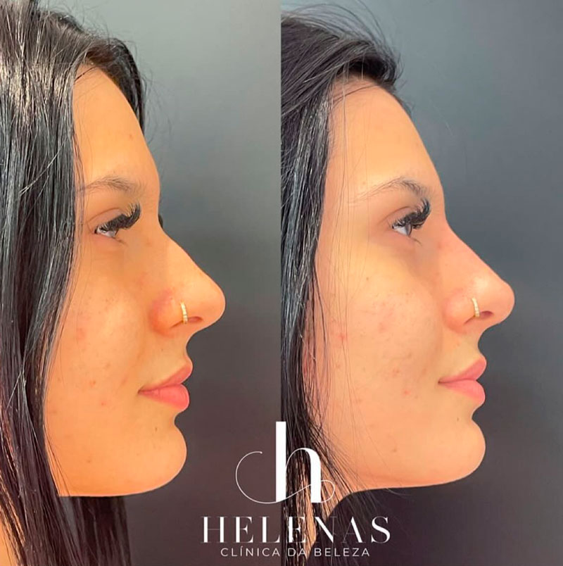 Ana Castela mostrou antes e depois de procedimento no nariz - Foto: Reprodução/ Instagram@anacastelacantora