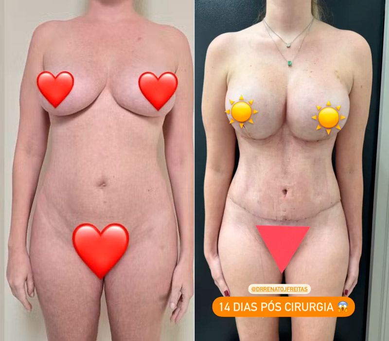 Bárbara Evans mostrou o corpo 14 dias após plásticas - Foto: Reprodução/ Instagram@barbaraevans22