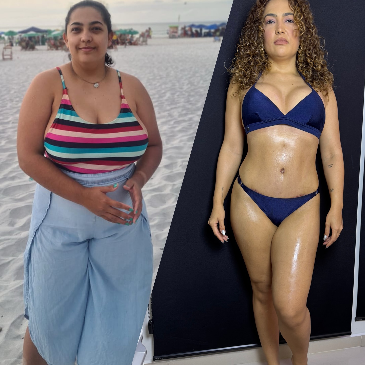 Camila Moura mostrou antes e depois das plásticas - Foto: Reprodução/ Instagram@camilamoura225