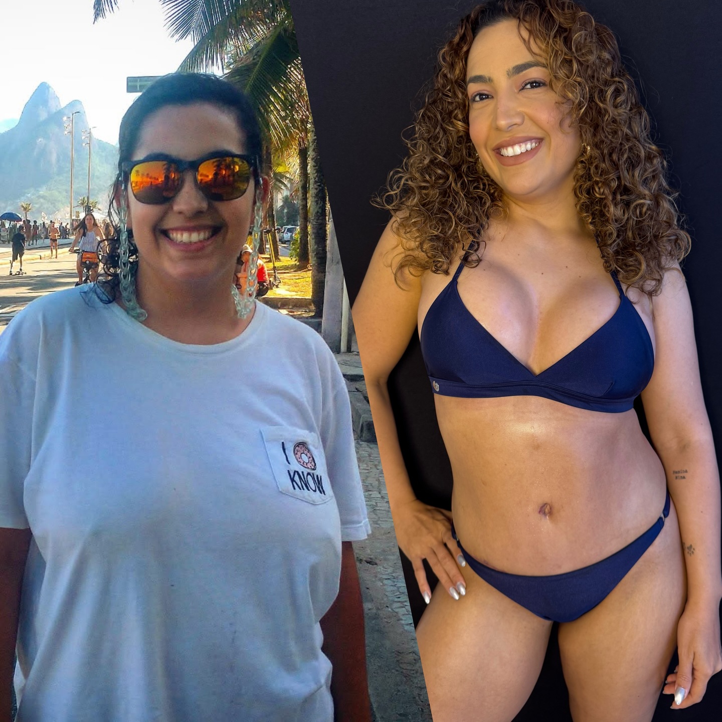 Camila Moura mostrou antes e depois das plásticas - Foto: Reprodução/ Instagram@camilamoura225