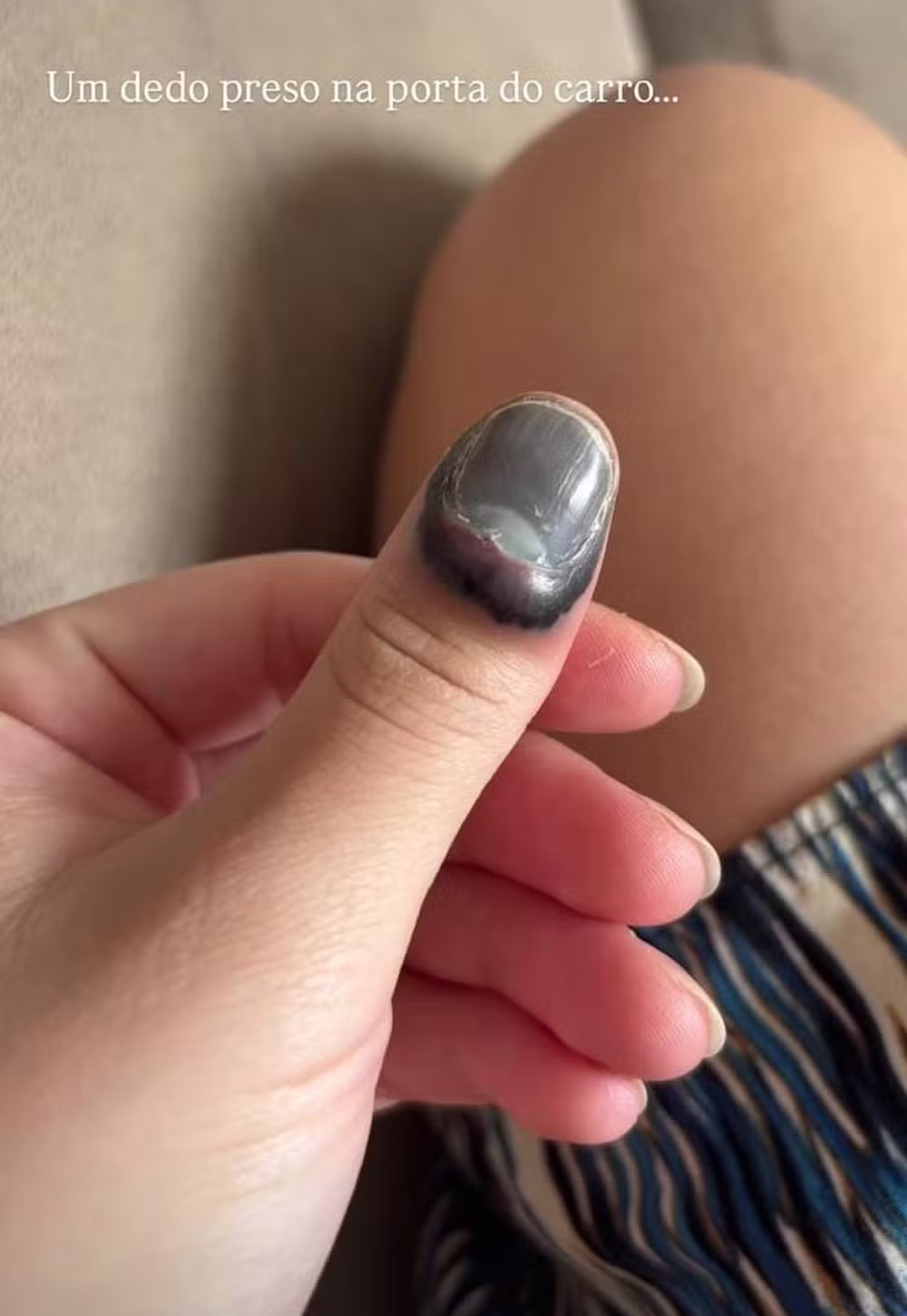 Carol Macedo passou por cirurgia após prender o dedo na porta do carro - Foto: Reprodução/ Instagram